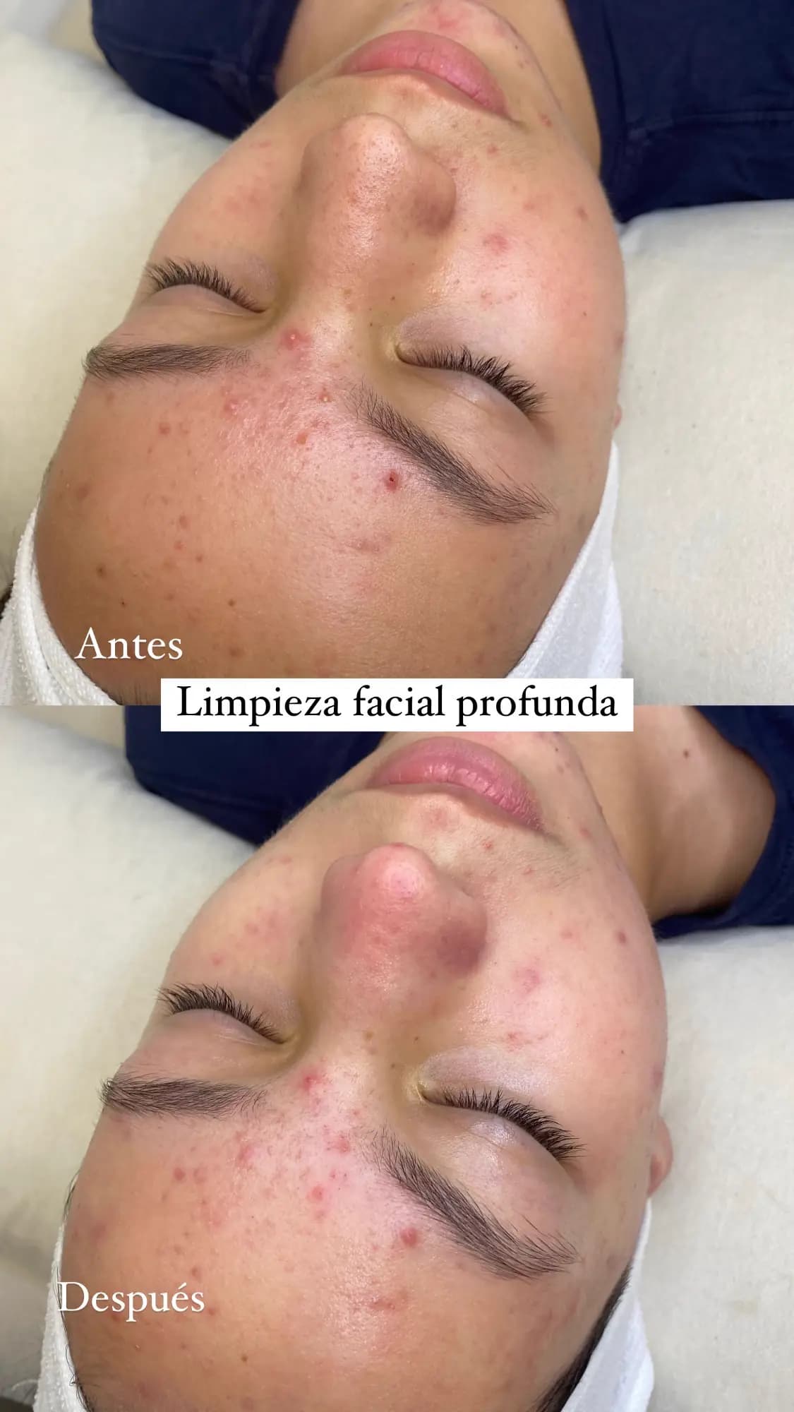 Resultado facial 2
