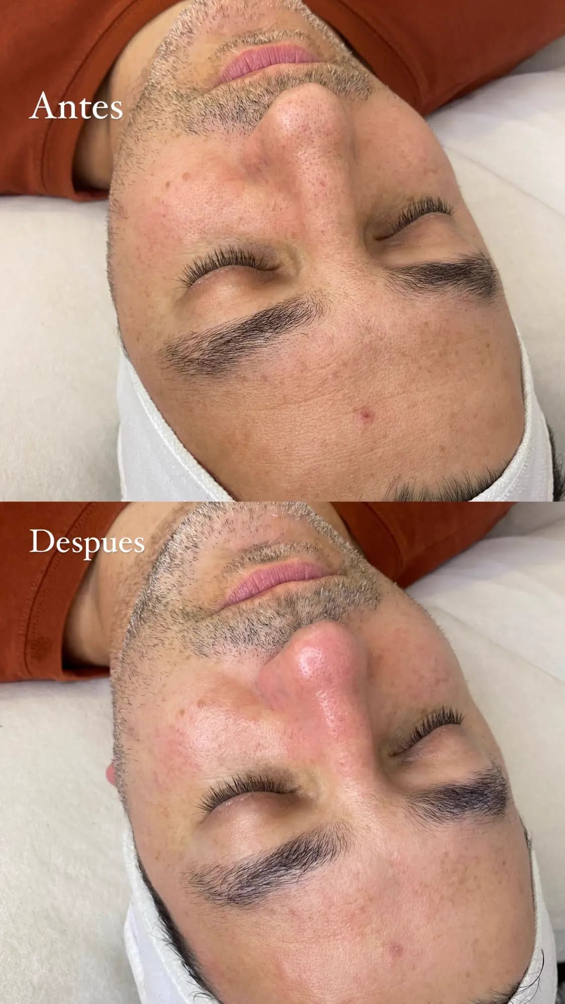 Resultado facial 6